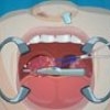 Operate Now Tonsil Surgery